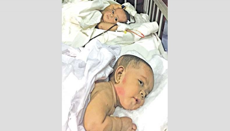 Conjoined twins separated at DMCH