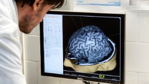 Alzheimer's drug shows promise in human trials