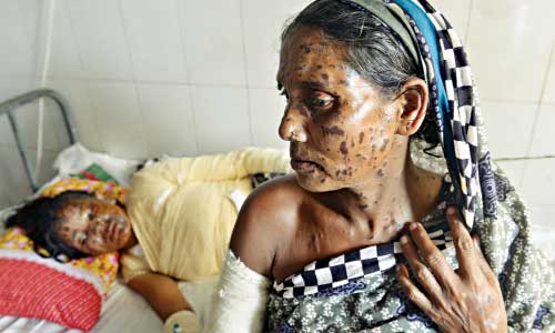 Mother, daughter burned in acid attack